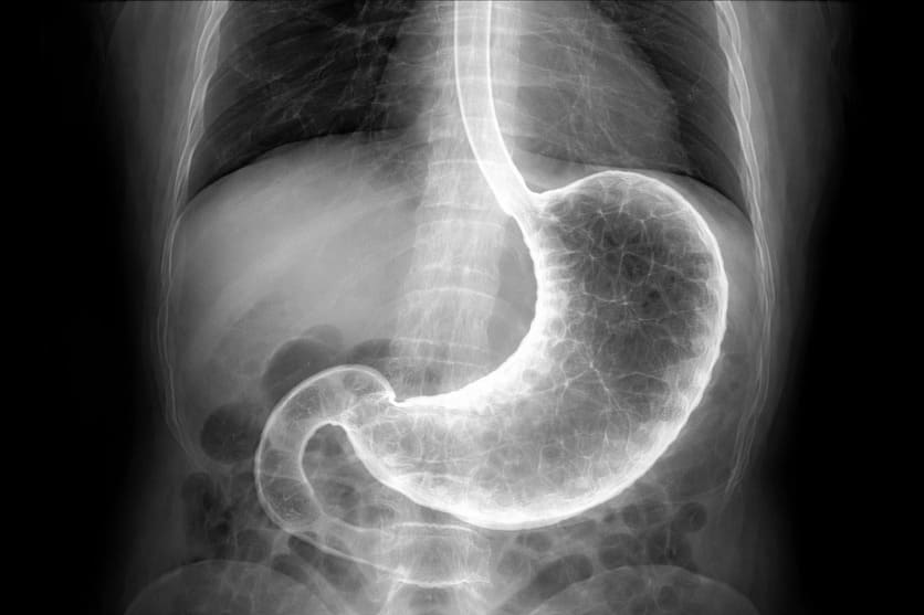 radiografia stomaco